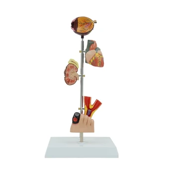 Демонстрационная Анатомическая модель Патологии Диабета, Модель Патологической Анатомии почек Показывает Симптомы диабета
