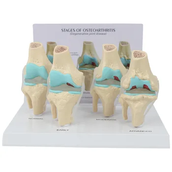 Набор моделей коленного сустава Анатомия человеческого тела 4-стадийный остеоартрит Коленный сустав для кабинета врача Учебное пособие