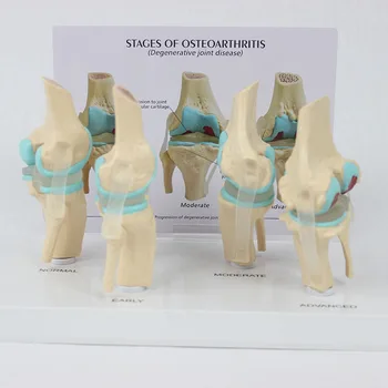 Набор моделей коленного сустава Анатомия человеческого тела 4-стадийный остеоартрит Коленный сустав для кабинета врача Учебное пособие Изображение 2